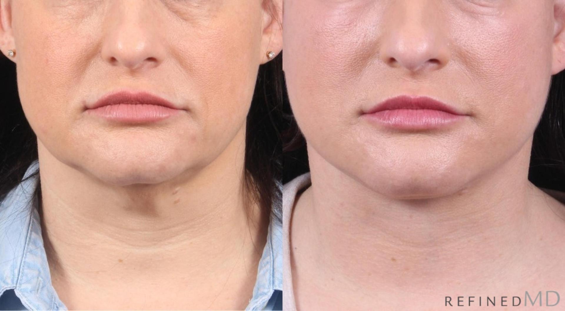 RefinedMD facelift result — Los Gatos, CA