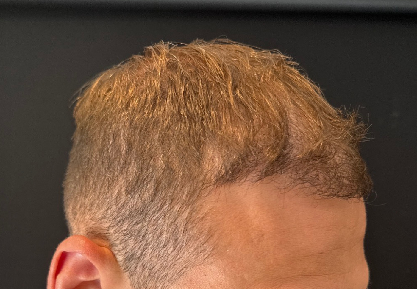 Dr. Faisal Al-Mufarrej hair restoration after — Sterling Heights, MI