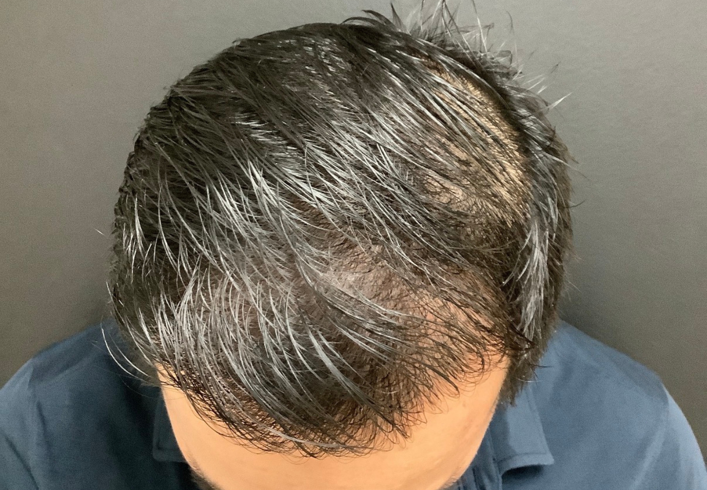 Dr. Faisal Al-Mufarrej hair restoration after — Sterling Heights, MI