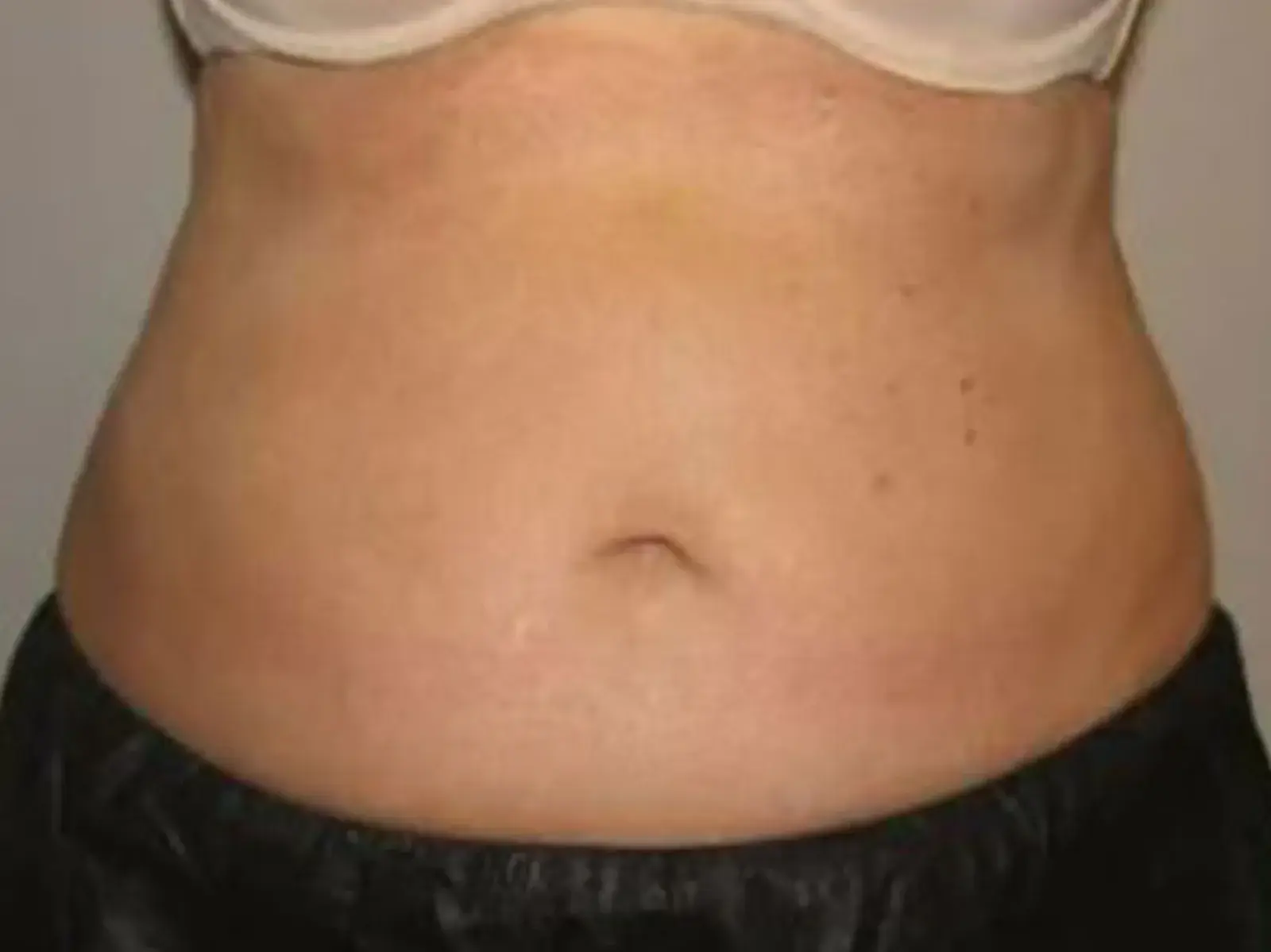 Dr. Faisal Al-Mufarrej fat freezing after — Sterling Heights, MI