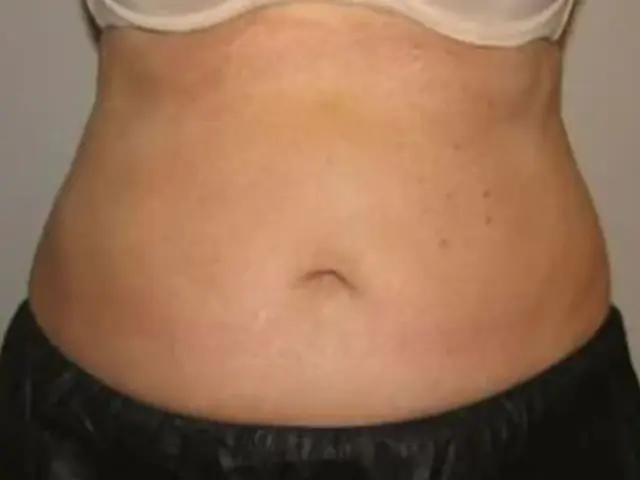 CoolSculpting after at Dr. Faisal Al-Mufarrej in Sterling Heights, MI
