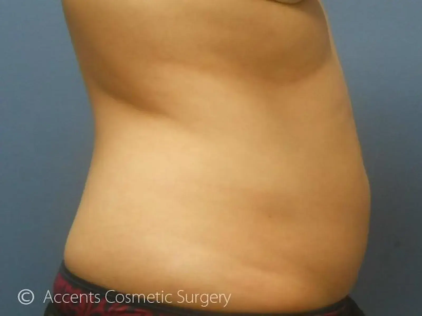 Dr. Faisal Al-Mufarrej fat freezing after — Sterling Heights, MI