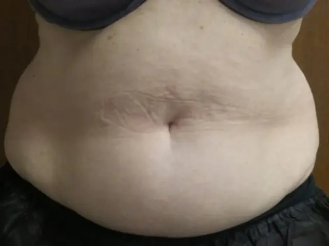 CoolSculpting before at Dr. Faisal Al-Mufarrej in Sterling Heights, MI
