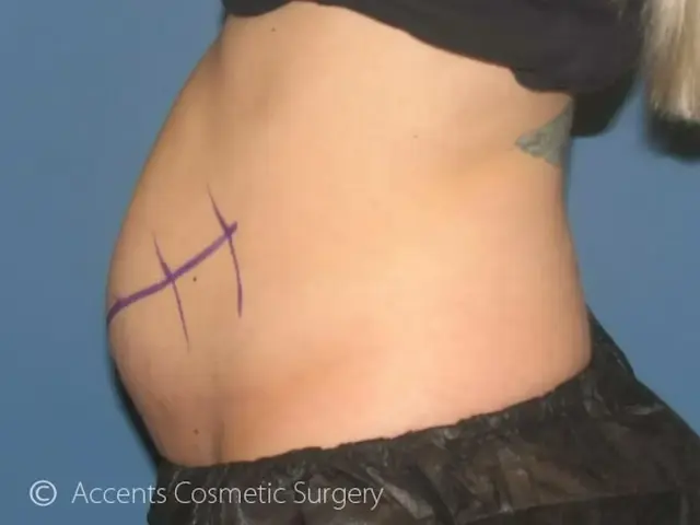 CoolSculpting before at Dr. Faisal Al-Mufarrej in Sterling Heights, MI