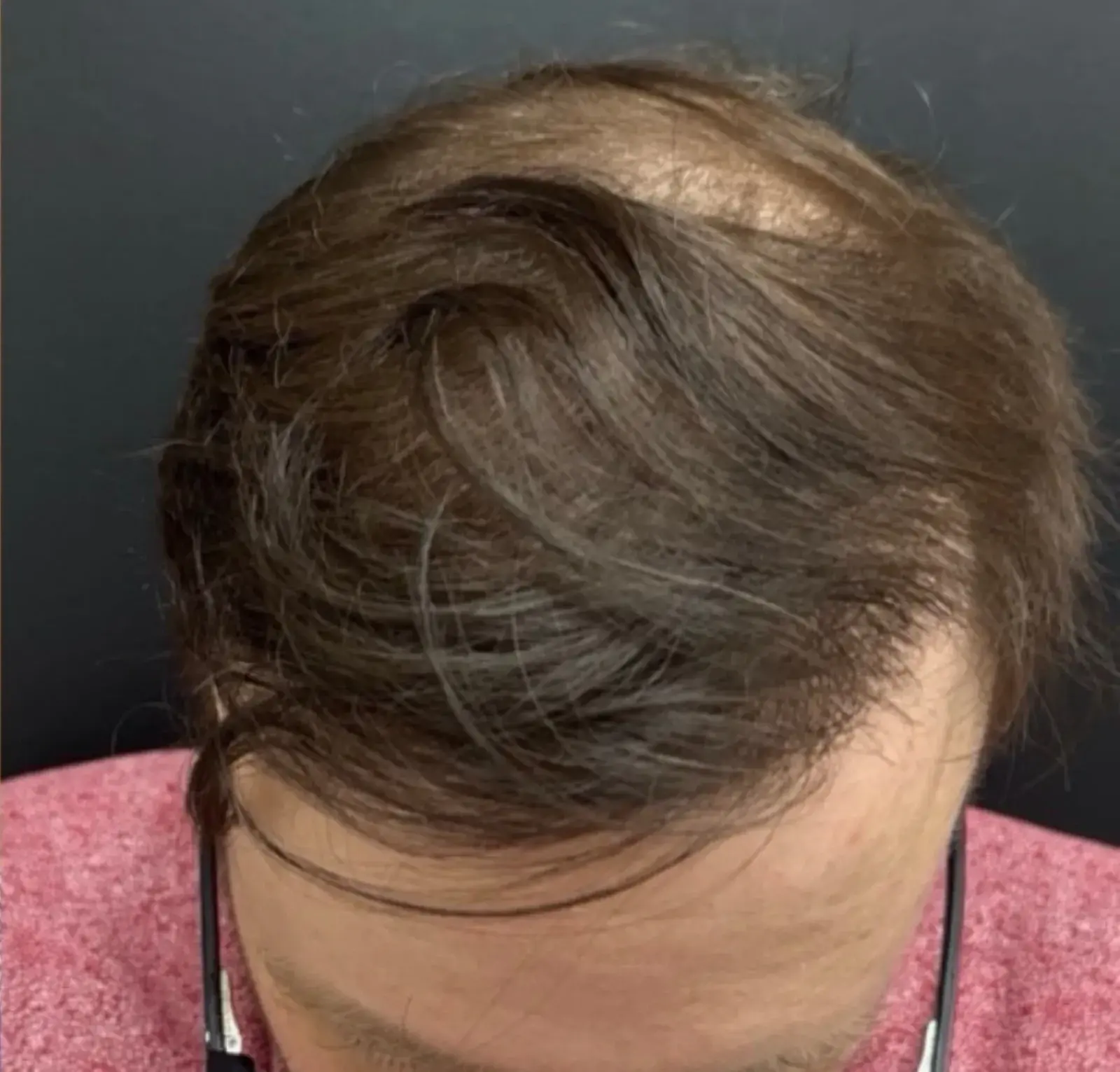 Dr. Faisal Al-Mufarrej hair restoration after — Sterling Heights, MI