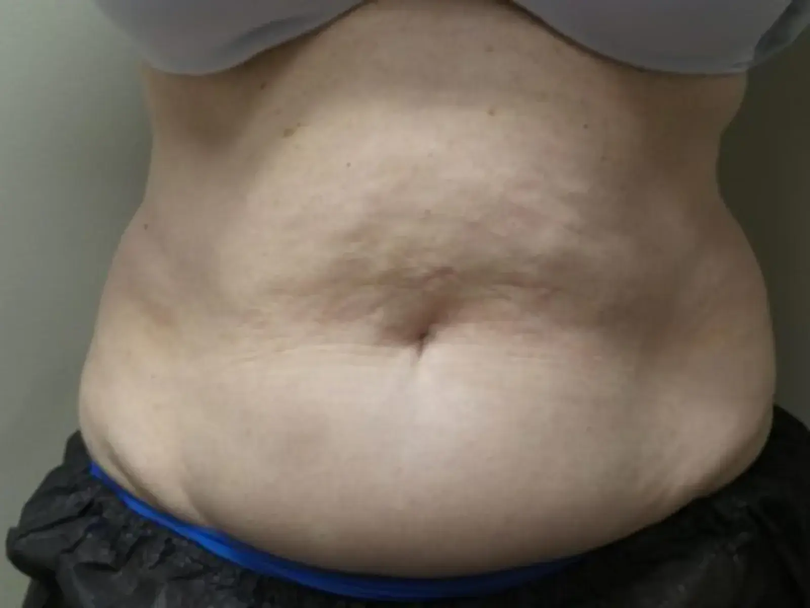Dr. Faisal Al-Mufarrej fat freezing after — Sterling Heights, MI