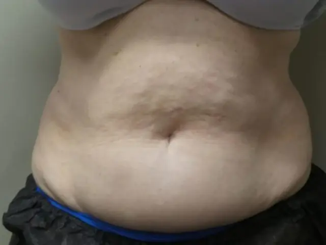 CoolSculpting after at Dr. Faisal Al-Mufarrej in Sterling Heights, MI