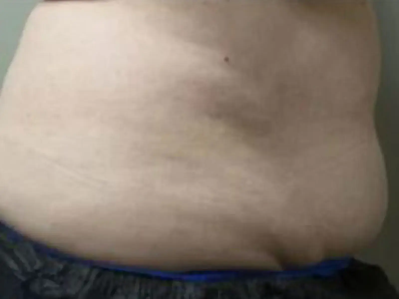 Dr. Faisal Al-Mufarrej fat freezing after — Sterling Heights, MI