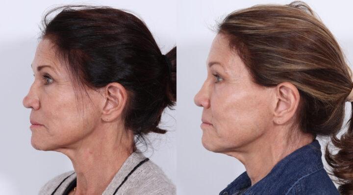 Patrick Cleveland Facial Plastic Surgery rhinoplasty result — West Palm Beach, FL