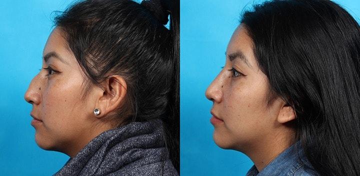 Patrick Cleveland Facial Plastic Surgery rhinoplasty result — West Palm Beach, FL
