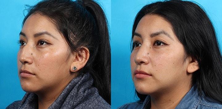 Patrick Cleveland Facial Plastic Surgery rhinoplasty result — West Palm Beach, FL