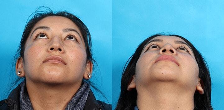 Patrick Cleveland Facial Plastic Surgery rhinoplasty result — West Palm Beach, FL