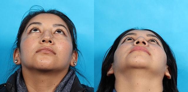 Functional Rhinoplasty result at Patrick Cleveland Facial Plastic Surgery in West Palm Beach, FL