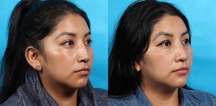 Patrick Cleveland Facial Plastic Surgery rhinoplasty result — West Palm Beach, FL