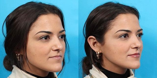 Lip Filler result at Patrick Cleveland Facial Plastic Surgery in West Palm Beach, FL