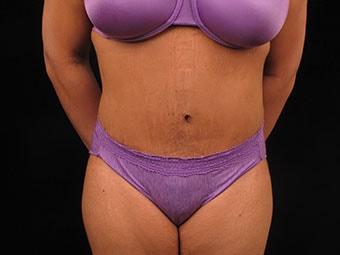 David A. Bottger, MD tummy tuck after — Newtown Square, PA