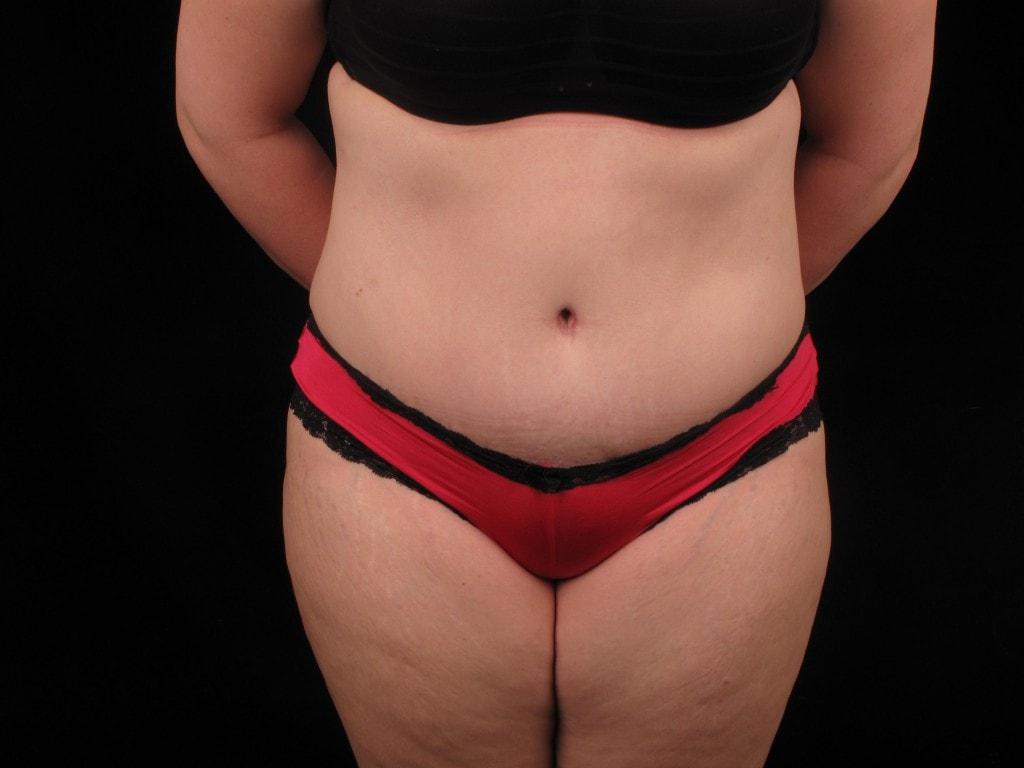 David A. Bottger, MD tummy tuck after — Newtown Square, PA