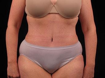 David A. Bottger, MD tummy tuck after — Newtown Square, PA