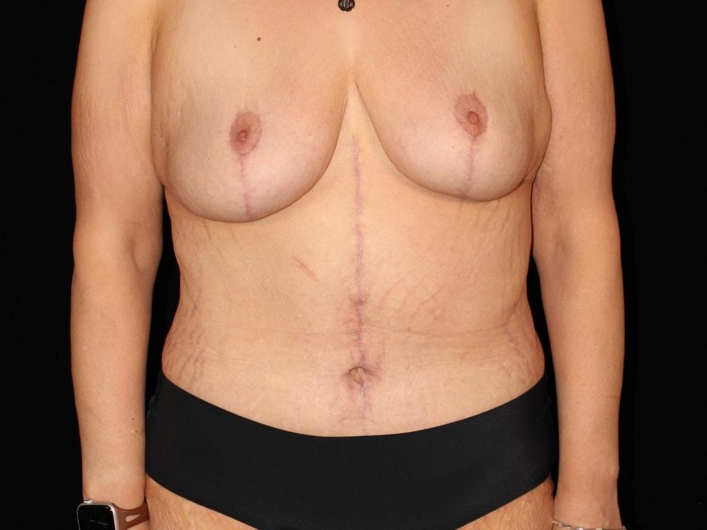 David A. Bottger, MD mommy makeover after — Newtown Square, PA