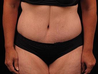 David A. Bottger, MD tummy tuck after — Newtown Square, PA