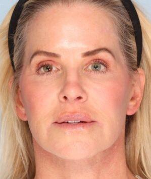 Daniel C. Mills, MD facelift after — Laguna Beach, CA