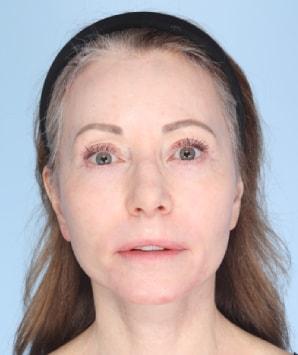 Daniel C. Mills, MD facelift after — Laguna Beach, CA