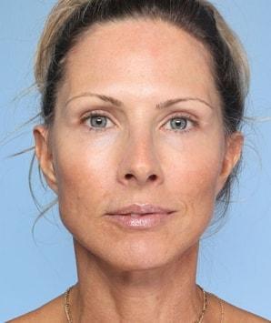 Daniel C. Mills, MD facelift after — Laguna Beach, CA