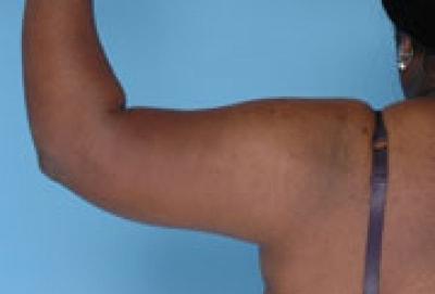 Daniel C. Mills, MD arm lift after — Laguna Beach, CA