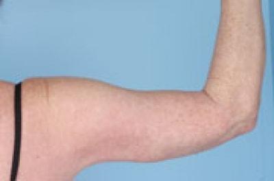 Daniel C. Mills, MD arm lift after — Laguna Beach, CA