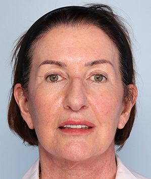 Daniel C. Mills, MD facelift after — Laguna Beach, CA
