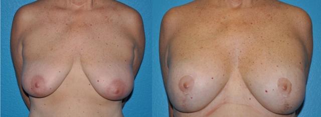 Breast Lift result at Dr. Candis Lovelace, MD, FACS in Fort Worth, TX