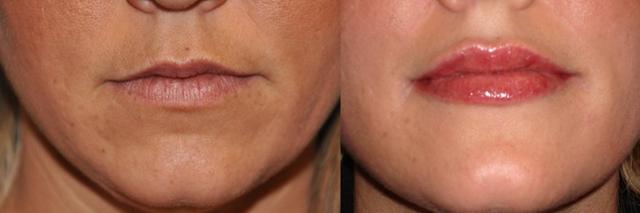 Dermal Fillers result at Dr. Candis Lovelace, MD, FACS in Keller, TX