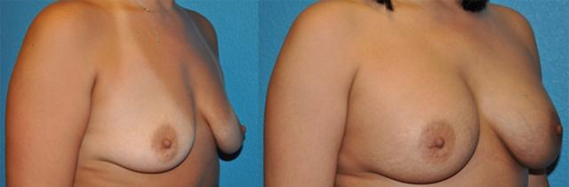 Breast Augmentation result at Dr. Candis Lovelace, MD, FACS in Fort Worth, TX