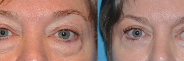 Blepharoplasty result at Dr. Candis Lovelace, MD, FACS in Fort Worth, TX