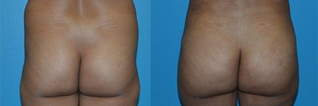 Brazilian Butt Lift result at Dr. Candis Lovelace, MD, FACS in Keller, TX