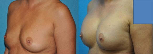 Breast Augmentation result at Dr. Candis Lovelace, MD, FACS in Fort Worth, TX