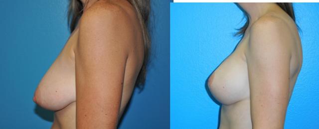 Breast Lift result at Dr. Candis Lovelace, MD, FACS in Fort Worth, TX