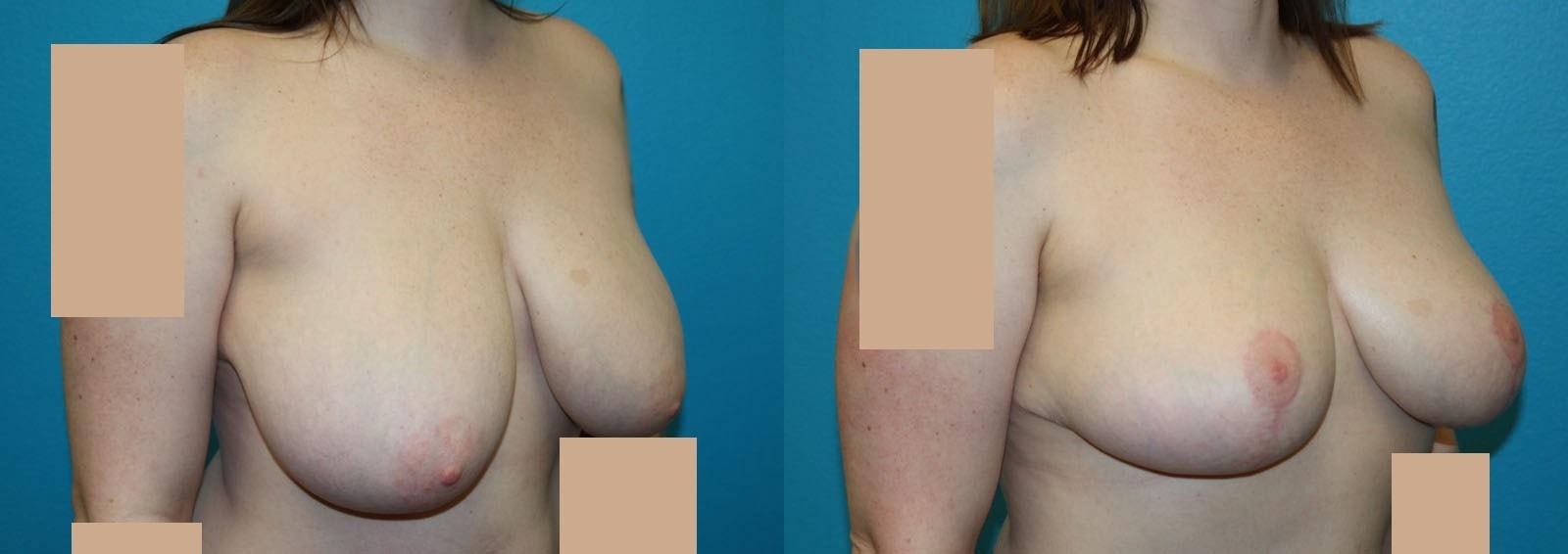Dr. Candis Lovelace, MD, FACS breast reduction result — Fort Worth, TX