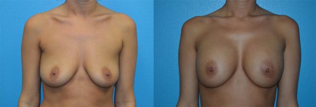 Breast Augmentation result at Dr. Candis Lovelace, MD, FACS in Fort Worth, TX
