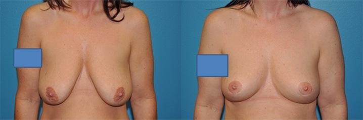 Dr. Candis Lovelace, MD, FACS breast lift result — Keller, TX
