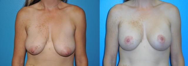 Breast Lift result at Dr. Candis Lovelace, MD, FACS in Fort Worth, TX