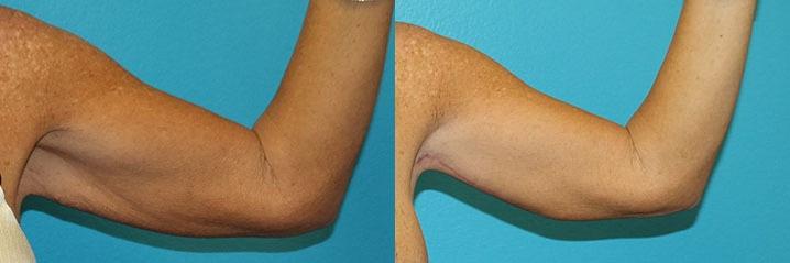 Dr. Candis Lovelace, MD, FACS arm lift result — Keller, TX
