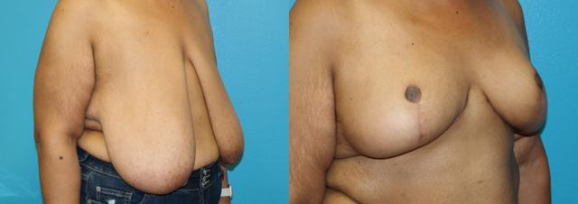 Breast Reduction result at Dr. Candis Lovelace, MD, FACS in Fort Worth, TX