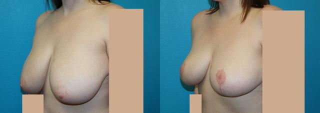 Breast Reduction result at Dr. Candis Lovelace, MD, FACS in Fort Worth, TX