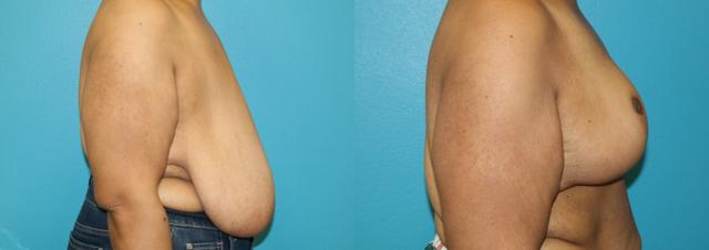 Breast Reduction result at Dr. Candis Lovelace, MD, FACS in Fort Worth, TX