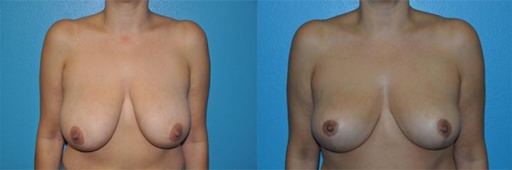 Dr. Candis Lovelace, MD, FACS breast lift result — Keller, TX
