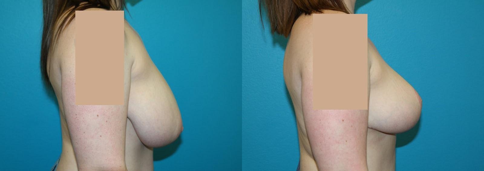 Dr. Candis Lovelace, MD, FACS breast reduction result — Fort Worth, TX