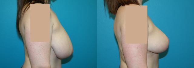 Breast Reduction result at Dr. Candis Lovelace, MD, FACS in Fort Worth, TX
