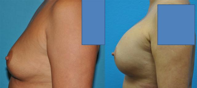 Breast Augmentation result at Dr. Candis Lovelace, MD, FACS in Fort Worth, TX