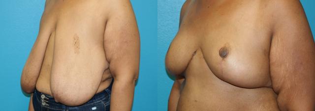 Breast Reduction result at Dr. Candis Lovelace, MD, FACS in Fort Worth, TX